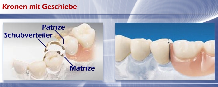 Kronen mit Geschiebe