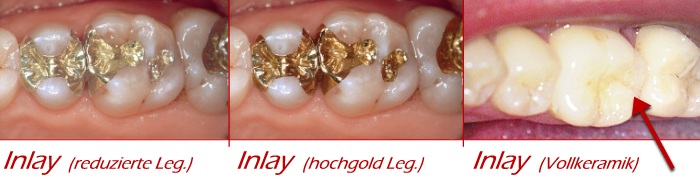 Inlays aus verschiedenen Werkstoffen