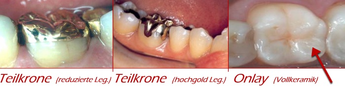 Onlays und Teilkronen aus verschiedenen Werkstoffen