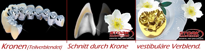 Teilverblendete Kronen aus versiedenen Werkstoffen