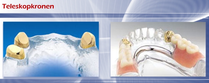 Teleskopkronen