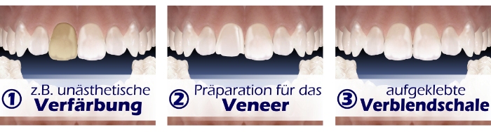 Beispiel für eine Veneerversorgung