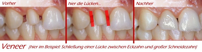 Hier im Beispiel: Lückenschluß durch ein Vollkeramikveneer